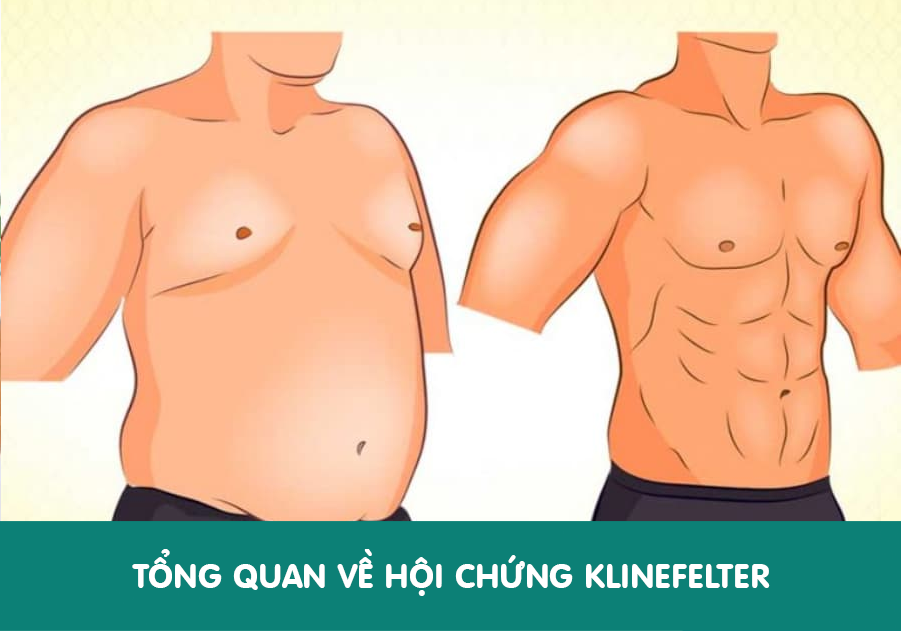 Tong-quan-ve-hoi-chung-Klinefelter