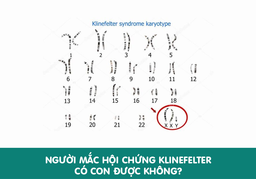 Nguoi-mac-hoi-chung-Klinefelter-co-di-truyen-khong